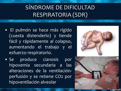marina belen alvarez|Recién nacido a término con dificultad respiratoria: enfoque .